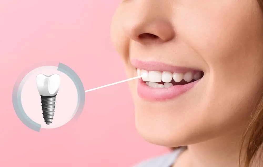 Recovery Tips After a Dental Implant